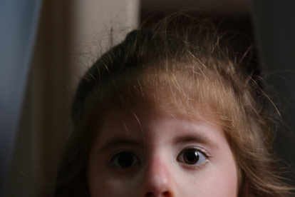 Ana Paula Vera sufre el síndrome de Moebius.