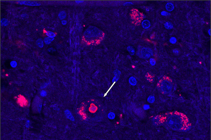 Tejido cerebral de un paciente con SCA4. El azul marca el ADN celular y el rojo una proteína que aumenta cuando se interrumpe el reciclaje de proteínas.
