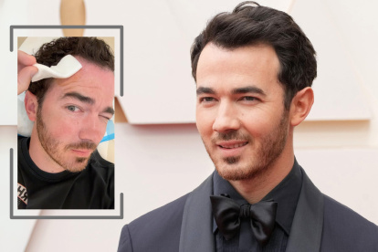 Nick Jonas fue operado por un carcinoma basocelular.