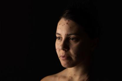 La aparición de erupciones en la piel es la principal característica de la varicela.