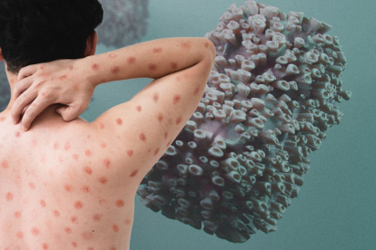 Reconocer los síntomas y buscar atención médica de manera oportuna es crucial para controlar la propagación del virus