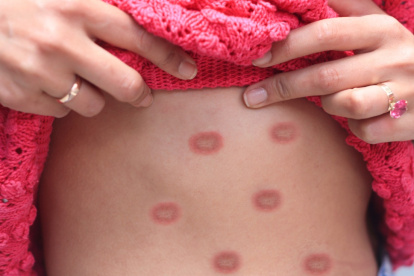 Viruela del mono es declarada emergencia de salud pública global.