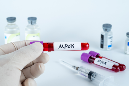 La mejor forma de detectar la presencia de la viruela del mono es a través de pruebas de laboratorio