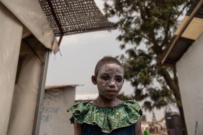FOTODELDÍA Goma (República Democrática del Congo), 16/08/2024.- Lucie Habimana, de 13 años, tiene la cara cubierta con ungüento después de recibir tratamiento para el mpox en el Centro de Salud Munigi en Munigi, República Democrática del Congo, el 16 de agosto de 2024. El Centro Europeo para la Prevención y el Control de Enfermedades (ECDC) advirtió que es probable que Europa registre más casos importados debido a la propagación del virus en varias naciones africanas después de que la Organización Mundial de la Salud declarara la propagación del mpox en África como una emergencia sanitaria mundial. El mpox pertenece a la misma familia de virus que la viruela, pero causa síntomas más leves como fiebre, escalofríos y dolores corporales. EFE/EPA/MOISE KASEREKA