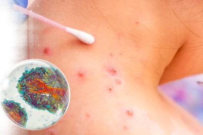 Los casos registrados en 2024 han sido cinco y los síntomas fueron leves, asegura el MSP.