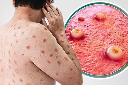 Hay cinco casos de viruela del mono en Ecuador, pero no de la nueva variante.