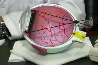 El síndrome de ojo seco puede causar lesiones en la superficie ocular que podrían dañar la córnea.