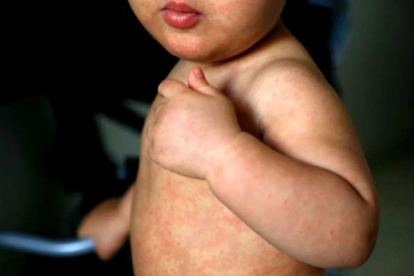 El sarampión produce fiebre alta y machas rojas en el rostro y en el cuerpo.