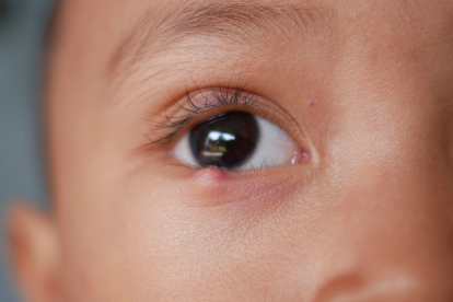 El herpes labial en niños puede causar daños oculares graves si no se trata a tiempo.