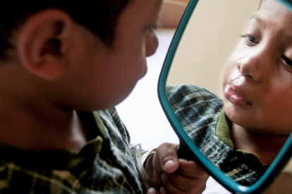 La Fundación Operación Sonrisa trabaja para mejorar la calidad de vida de niños, jóvenes y adultos con fisura labiopalatina