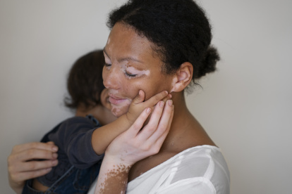 El vitiligo afecta entre el 0,5 % y el 2 % de la población mundial