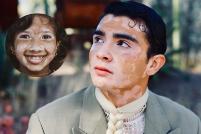 Millones viven con vitíligo: una condición que requiere comprensión médica y empatía social.