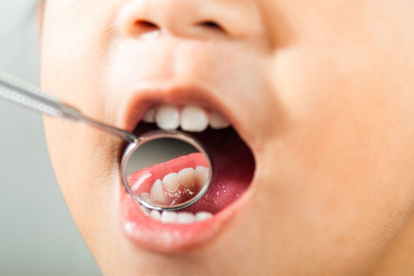 La caries dental continúa siendo una de las enfermedades más frecuentes en Ecuador, afectando especialmente a niños y escolares.