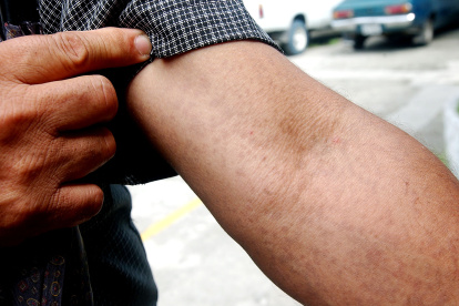 Casos de enfermedades en la piel suben 27,9% en Guayaquil en 2026.