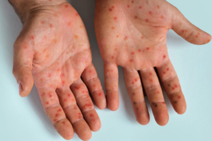 Erupciones o lesiones cutáneas aparecen en la cara, las palmas de las manos y las plantas de los pies en casos de viruela símica o mpox.