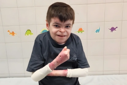 Leo, de 12 años, inicia en Sevilla la terapia génica Vyjuvek para tratar la Piel de Mariposa.