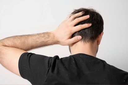La psoriasis en el cuero cabelludo puede ser una señal de artritis psoriásica, por lo que es importante consultar con un médico sobre su aparición.