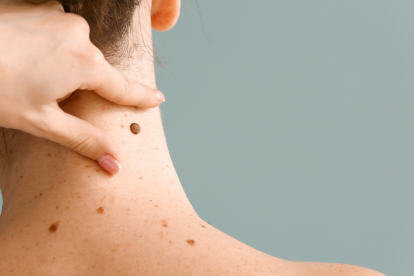 Moderna y Merck anunciaron resultados positivos de una terapia personalizada de ARNm contra el melanoma.