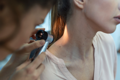 Tener más de 50 lunares en el cuerpo sería una señal de un mayor riesgo de desarrollar cáncer.