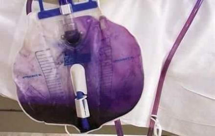 Diez días después de hospitalización tras un derrame cerebral, la orina de una mujer apareció color morado. Los médicos investigaron la razón.