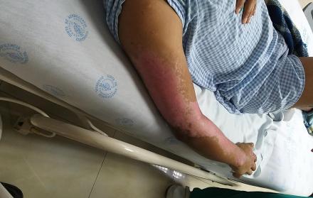 Las quemaduras lesionan la piel. En algunas ocasiones las heridas son más graves.