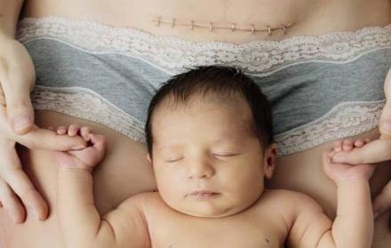 Según la experta consultada, hay condiciones por las que la mejor opción para algunas mujeres sería la cesárea.