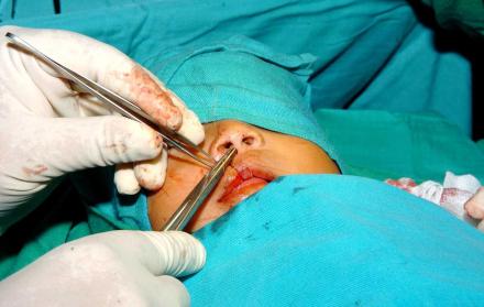 Las operaciones son gratuitas y se realizarán en el Hospital Los Ceibos del IESS.