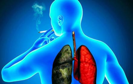 El cáncer de pulmón, que se ve en mayor número en los fumadores, es el responsable del fallecimiento anual de más de 1,8 millones de personas en el mundo.