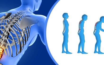 Daño causado por la osteoporosis.