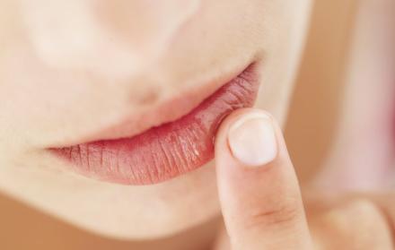 Herpes labial