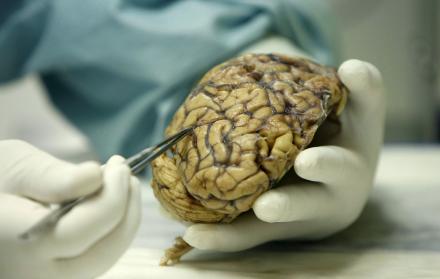 Un científico observa un cerebro humano enfermo de alzheimer, en una foto de archivo.