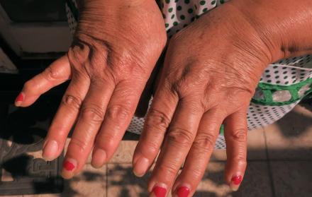 Una mujer muestra su manos con artritis reumatoide en una imagen de archivo.