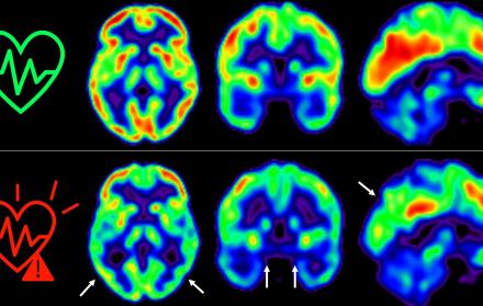Las imágenes representan la captación de glucosa en el cerebro en individuos de mediana edad con bajo (arriba) o alto (abajo) riesgo cardiovascular sostenido 5 años.