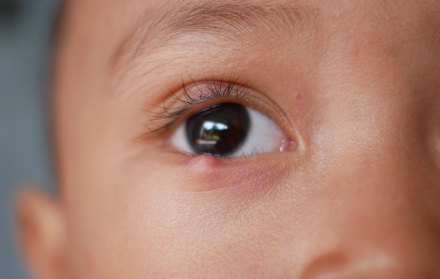 El herpes labial en niños puede causar daños oculares graves si no se trata a tiempo.