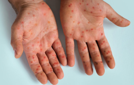 Erupciones o lesiones cutáneas aparecen en la cara, las palmas de las manos y las plantas de los pies.