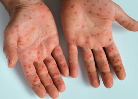 Ecuador activa alerta epidemiol&oacute;gica por caso de viruela s&iacute;mica Clado Ib