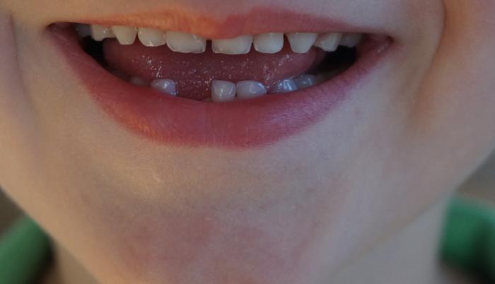 dientes de leche