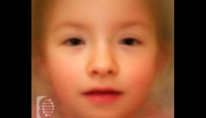 sindrome-TRAF7-enfermedad-rara-cara-foto