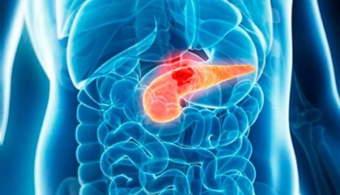 cancer-de-pancreas