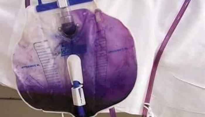 Diez días después de hospitalización tras un derrame cerebral, la orina de una mujer apareció color morado. Los médicos investigaron la razón.