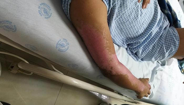 Las quemaduras lesionan la piel. En algunas ocasiones las heridas son más graves.