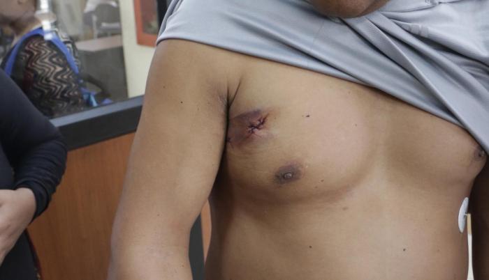 La víctima recibió un tiro en el brazo derecho y en la parte superior del tórax.