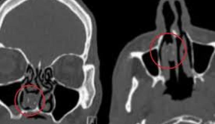 Se puso la droga en la nariz para pasar los controles de seguridad en la cárcel. Lo logró, pero nunca más la logró sacar.