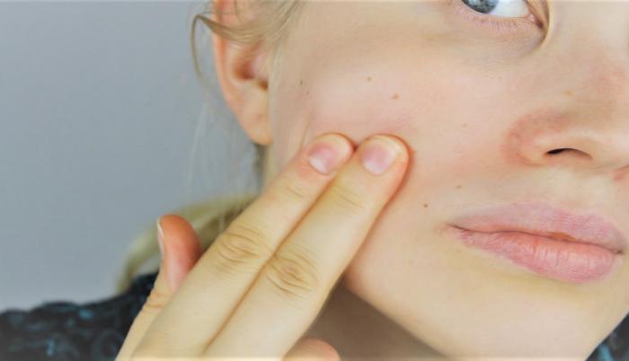La psoriasis en una etapa agravada, producto del estrés.
