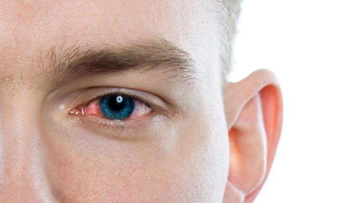 conjuntivitis