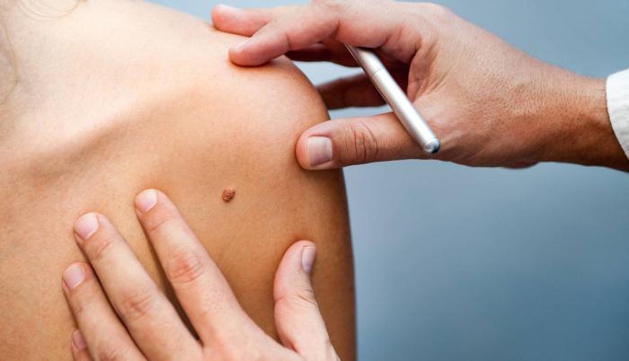 melanoma