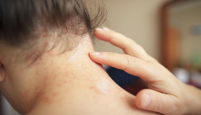 Mujer con psoriasis