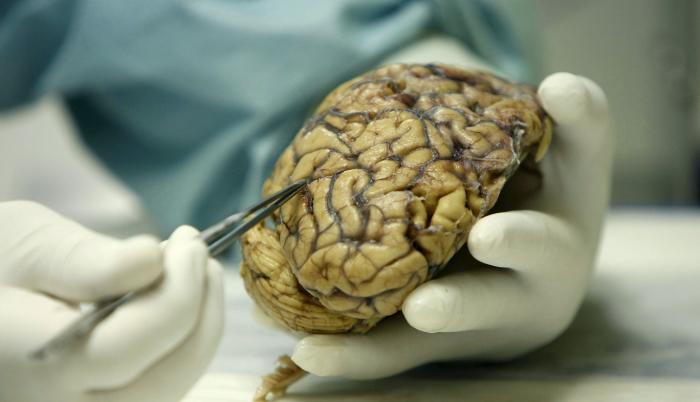 Un científico observa un cerebro humano enfermo de alzheimer, en una foto de archivo.