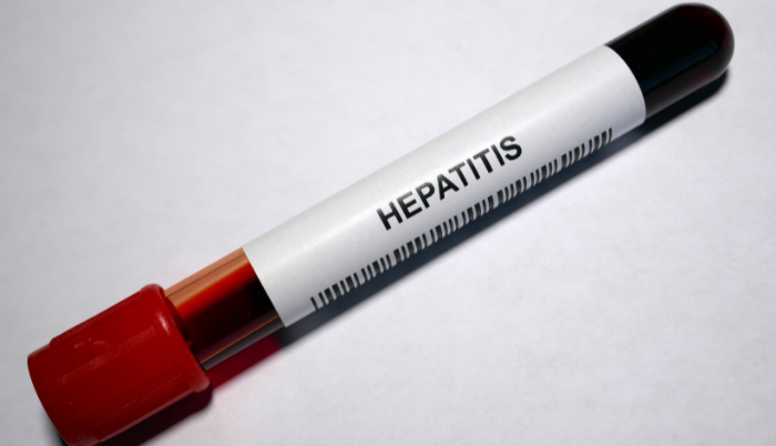 Hepatitis