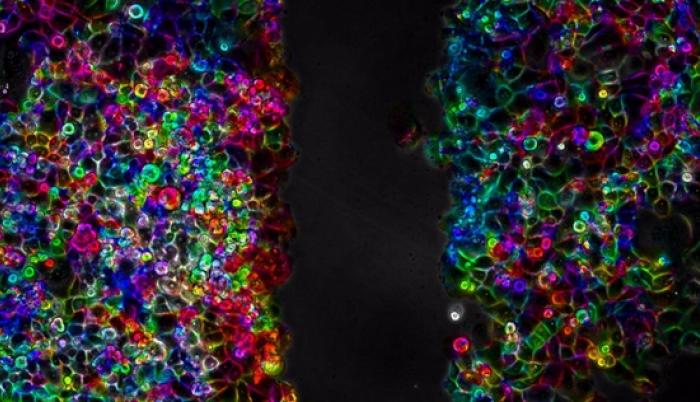 Células de cáncer de páncreas
